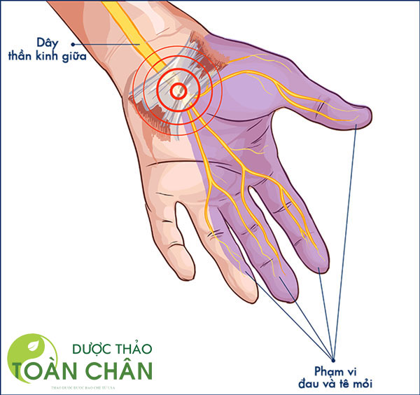 Nguyên nhân đau cổ tay thường gặp